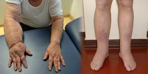 láb és ízületi fájdalomkezelés ricinusolaj az artrózis kezelésében