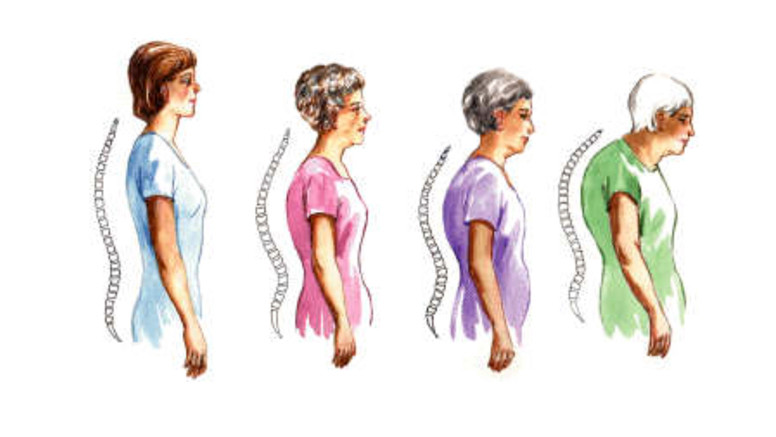 A nyaki gerinc csontritkulása. Női Egészség Éve 2020