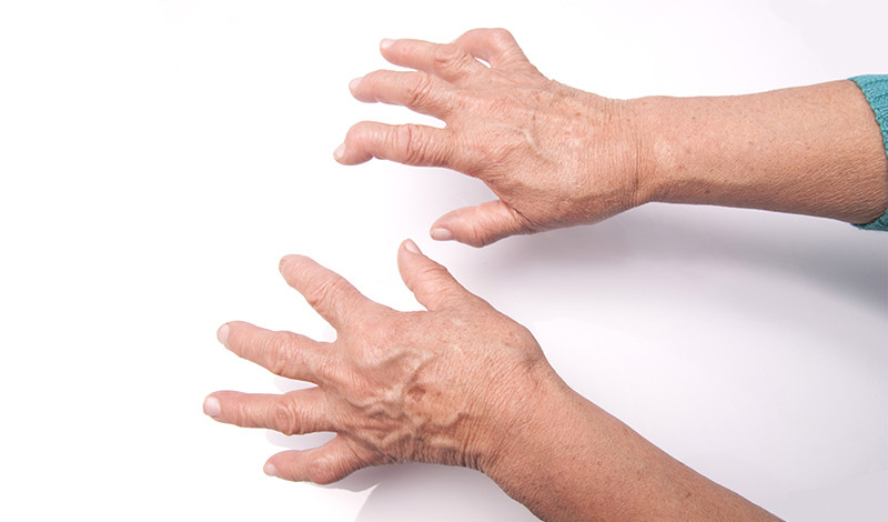 ízületi kezelés rheumatoid arthritis