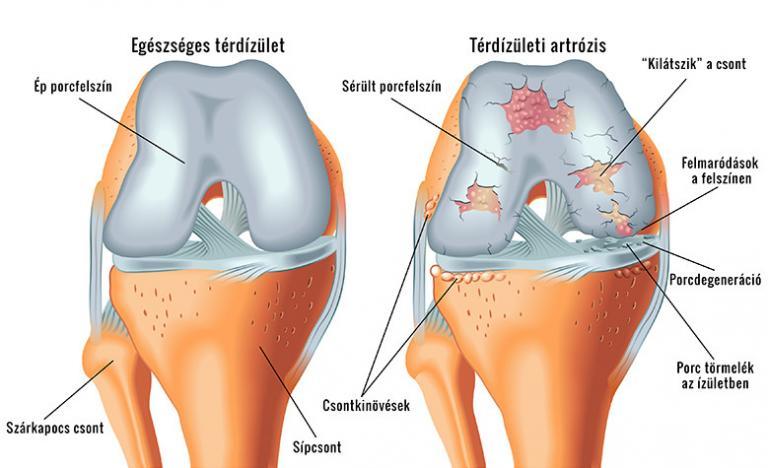 fájdalom sok ízületben poszt traumatikus artrosis kezelés
