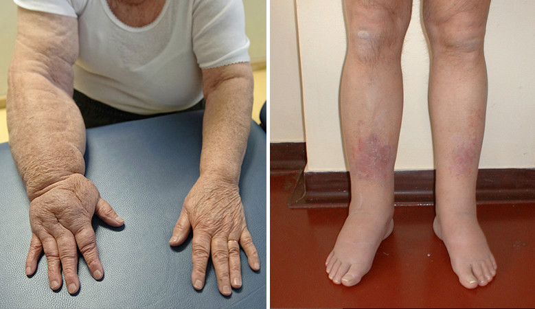 A bokaszalag szakadás fajtái, tünetei, kezelése