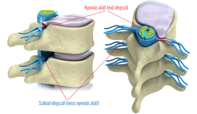 a gerinc orvosi kezelése súlyos hátfájás a hát alsó részén