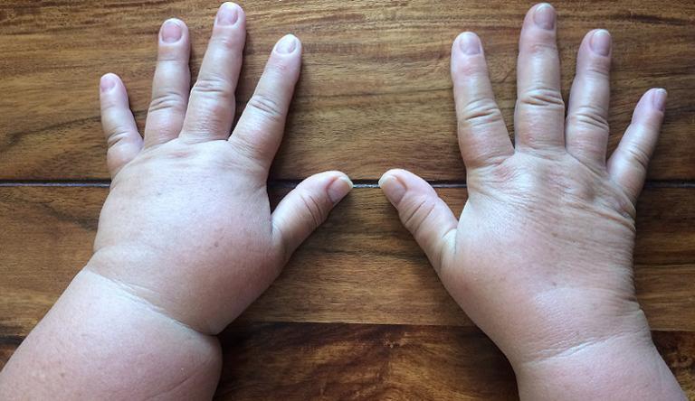 Súlyos betegséget is jelezhetnek a feldagadt ujjak | Házipatika