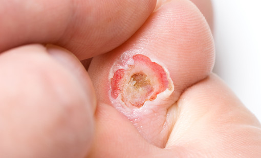 legjobb orvosság típusú cukorbetegség kezelése kezelő ujj lábak cukorbetegséggel