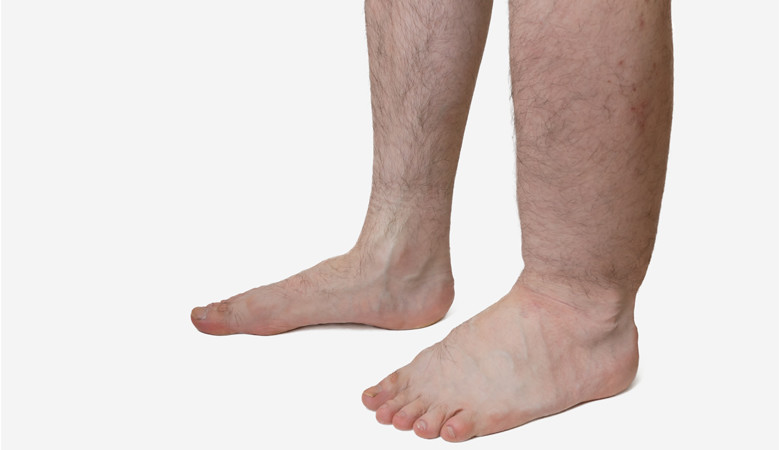 Az ödémás láb kezelése