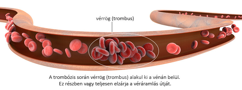 trombus, azaz vérrög kialakulás folyamata