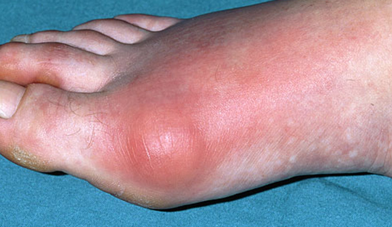 A lábfejet érintő 4 leggyakoribb betegség