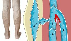bokaduzzanat kezelése ízületi ízületi lábkezelés áttekintése