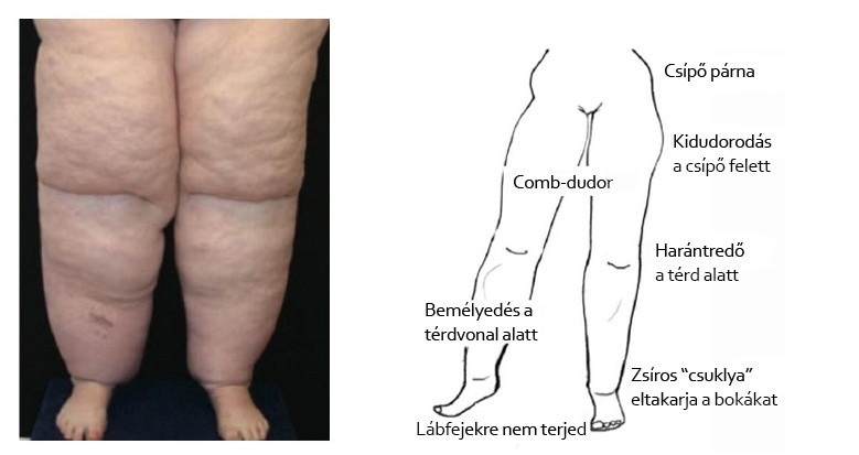 milyen betegségek vannak a lábak ízületeiben hogyan lehet gyógyítani a lábízület betegségét