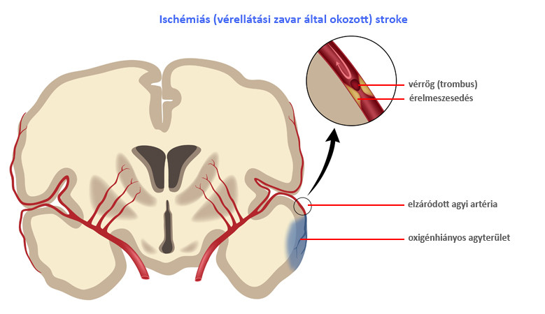 A stroke és tünetei