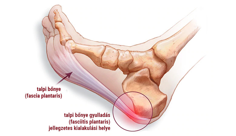 Sarok boka fájdalom, A sarok, a boka és a lábfej is fájhat Achilles-ín gyulladás miatt