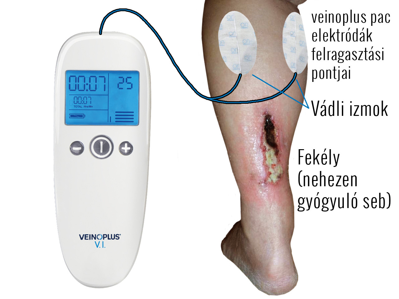 népszerű sebek kezelésére lábakon diabetes)