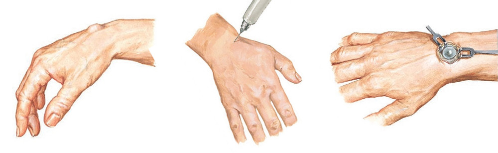 Csuklófájdalom - Hogyan kell kezelni a kéz csuklóízületét