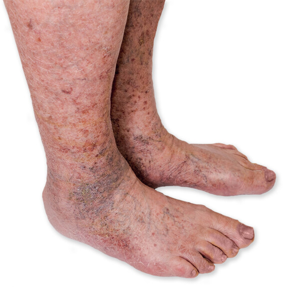Piros foltok a lábszáron - Bőrgyulladás November A borjún vörös folt viszket