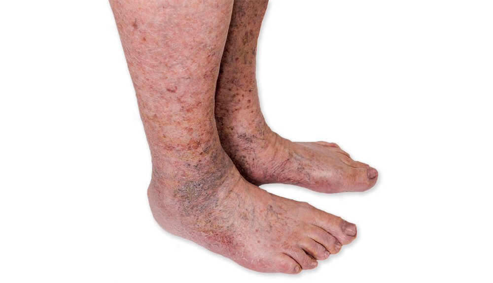A májbetegségek bőrtünetei