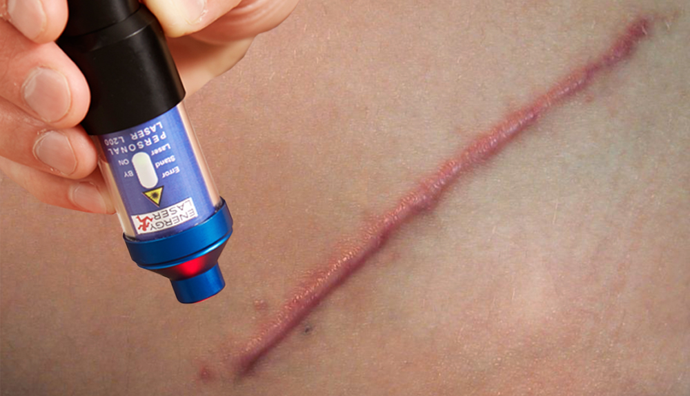 keloid treatment with soft laser