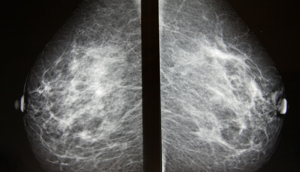 mammográfia, emlőrák szűrés, mellrák szűrés
