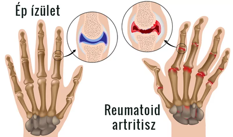 a reumatoid artritisz által okozott elváltozás