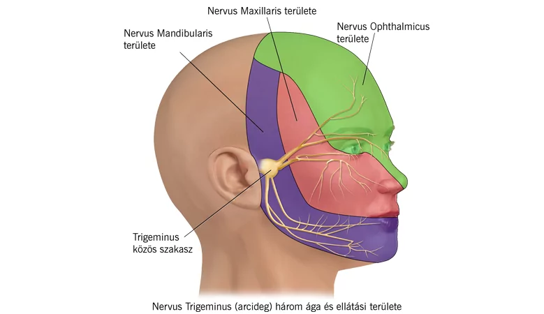 Arcideggyulladás, azaz trigeminus neuralgia