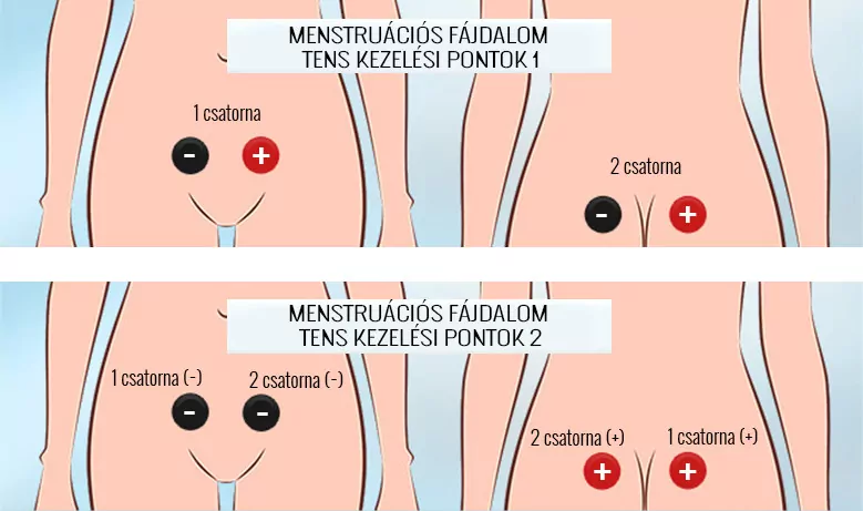 menstruációs görcsök fájdalom kezelése TENS-sel, kezelési pontok