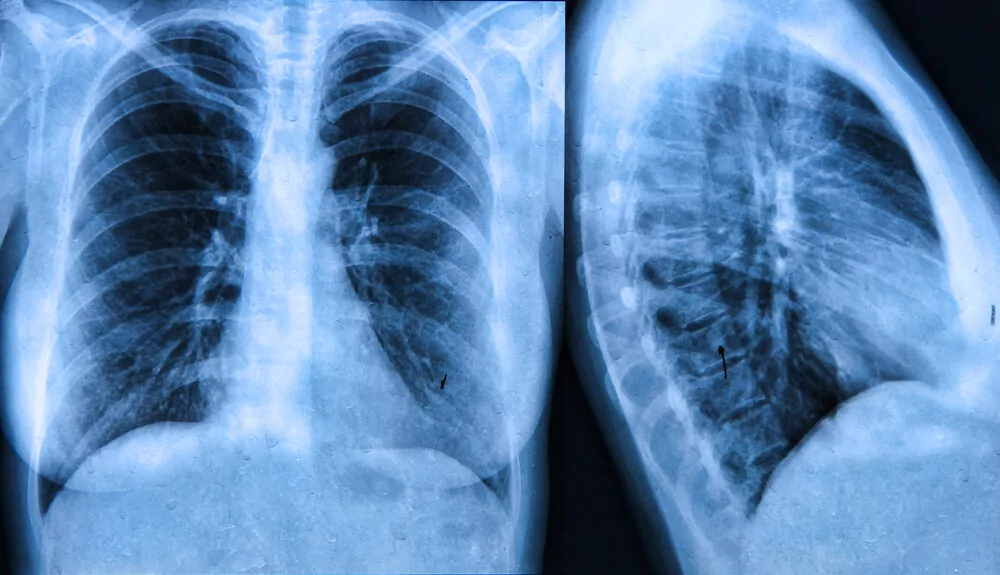 mellkas röntgen felvétel
